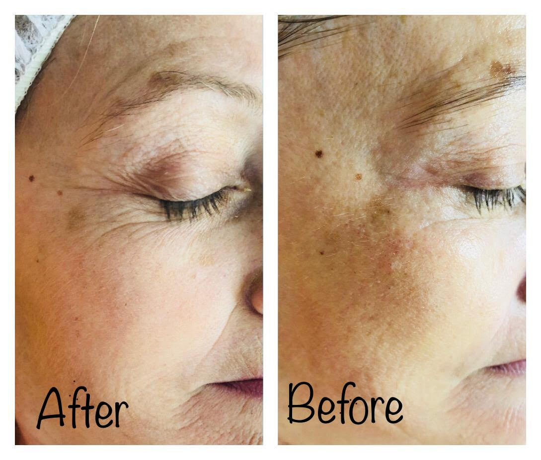 до и после витамин С PORTCARE